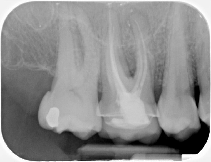 Fractured Tooth PA