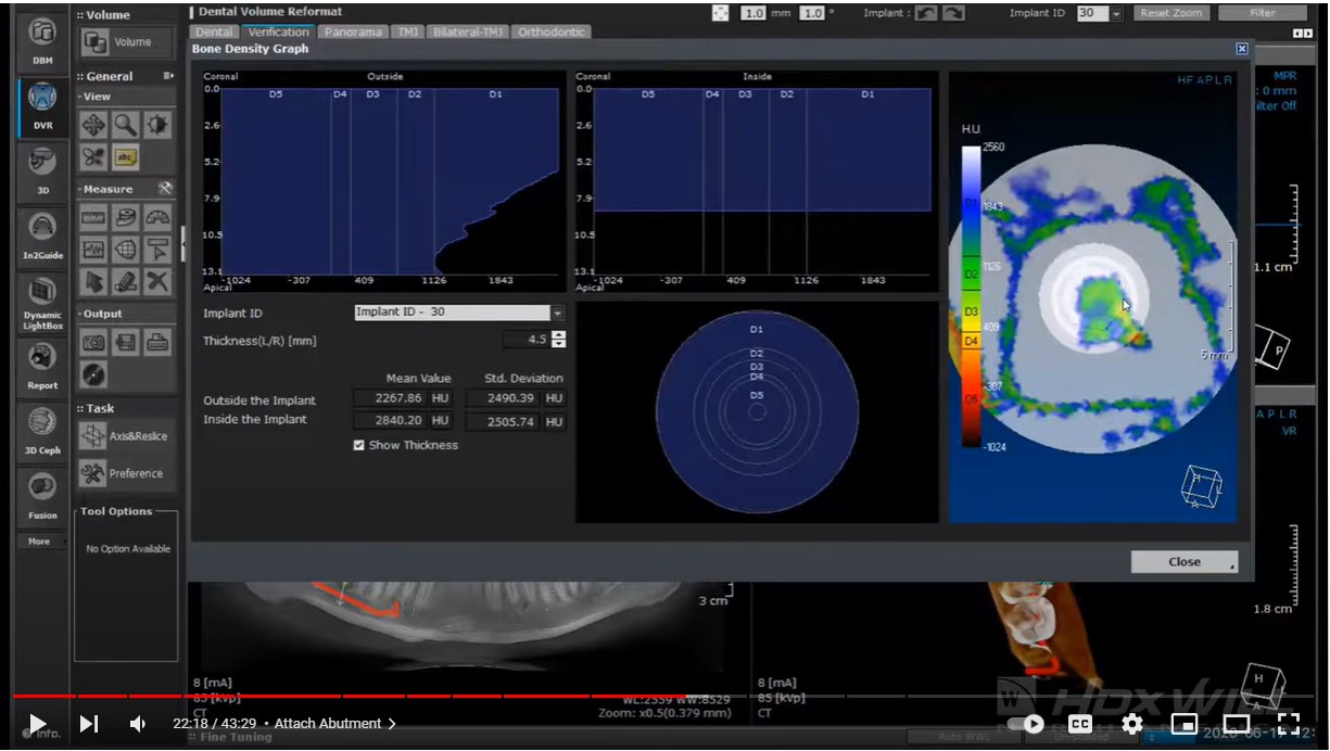 CBCT Bone Density Measurement