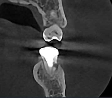 CBCT Coronal View Resorption 