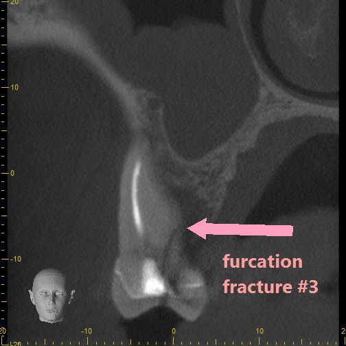 Coronal View of Root Fracture CBCT