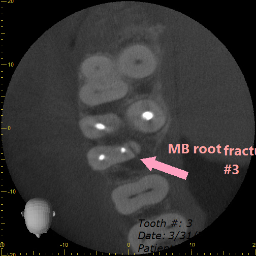 Axial view CBCT MB root fracture
