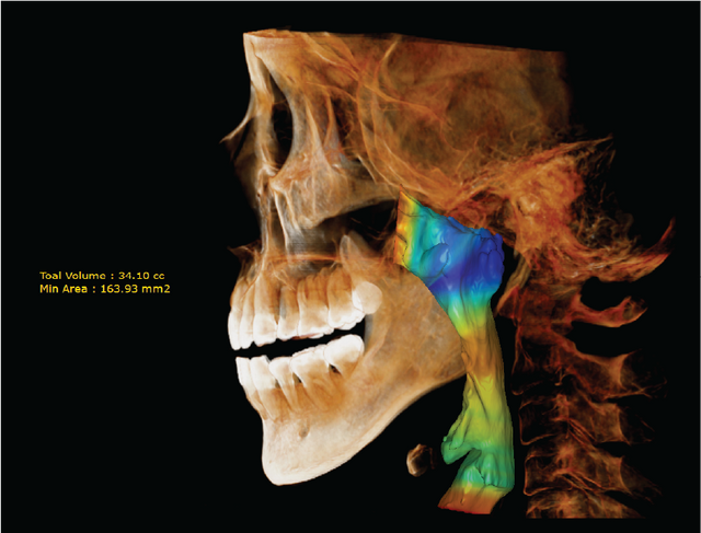 Large FOV CBCT Airway