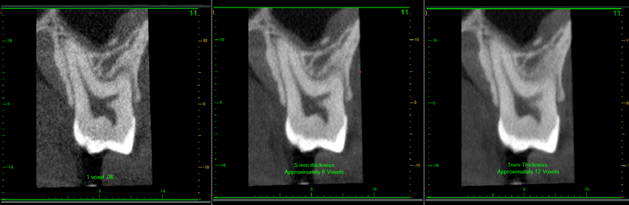 Varied Slice Thickness CBCT
