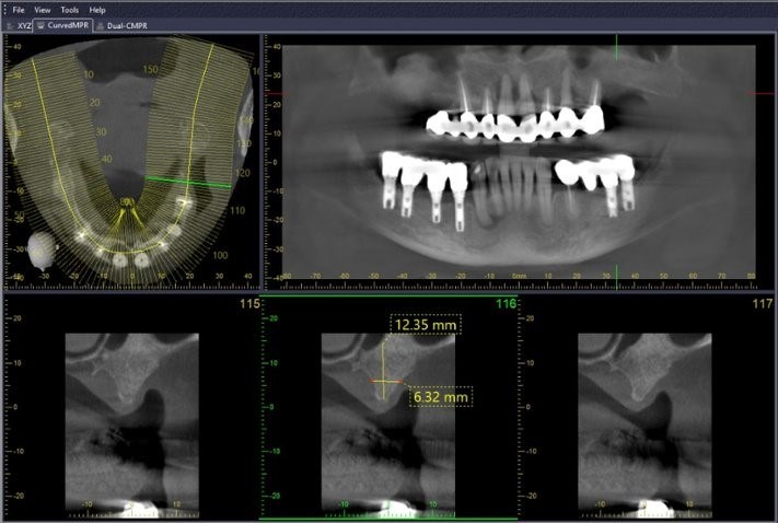 MPR Line CBCT Scan