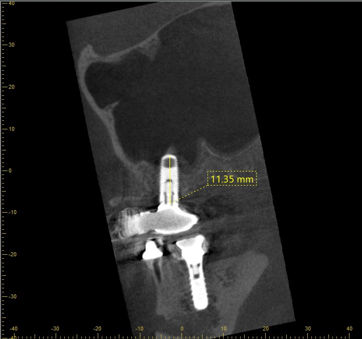 Correct CBCT Measurements