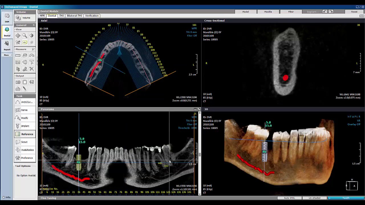 CBCT Mapping the Mandibular Canal