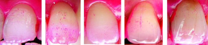 Close-up photos of five dye-stained teeth showing visible pink plaque adherence before applying a Smile Guard lozenge