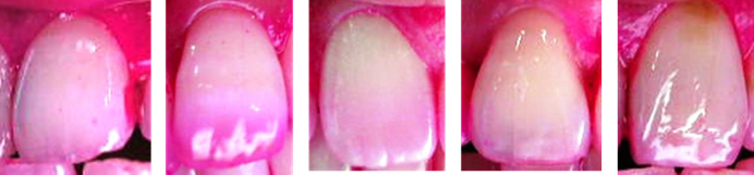 Close-up photos of the same five teeth showing visibly less plaque staining after taking a Smile Guard lozenge