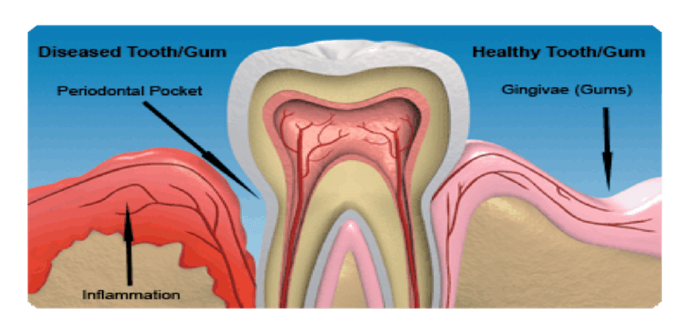 Cross-section diagram comparing a diseased tooth and gum with a periodontal pocket and inflammation to a healthy tooth and gum