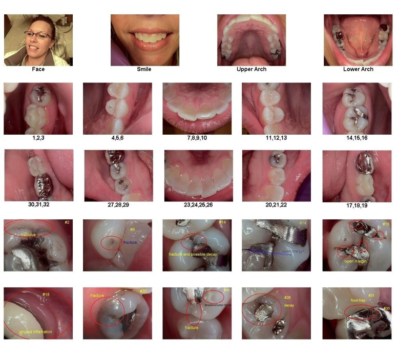 Grid of intraoral camera images from a one-minute exam, including patient face and smile photos, upper and lower arch views, and close-up tooth shots annotated with labels such as calculus, fracture, decay, open margin, and food trap