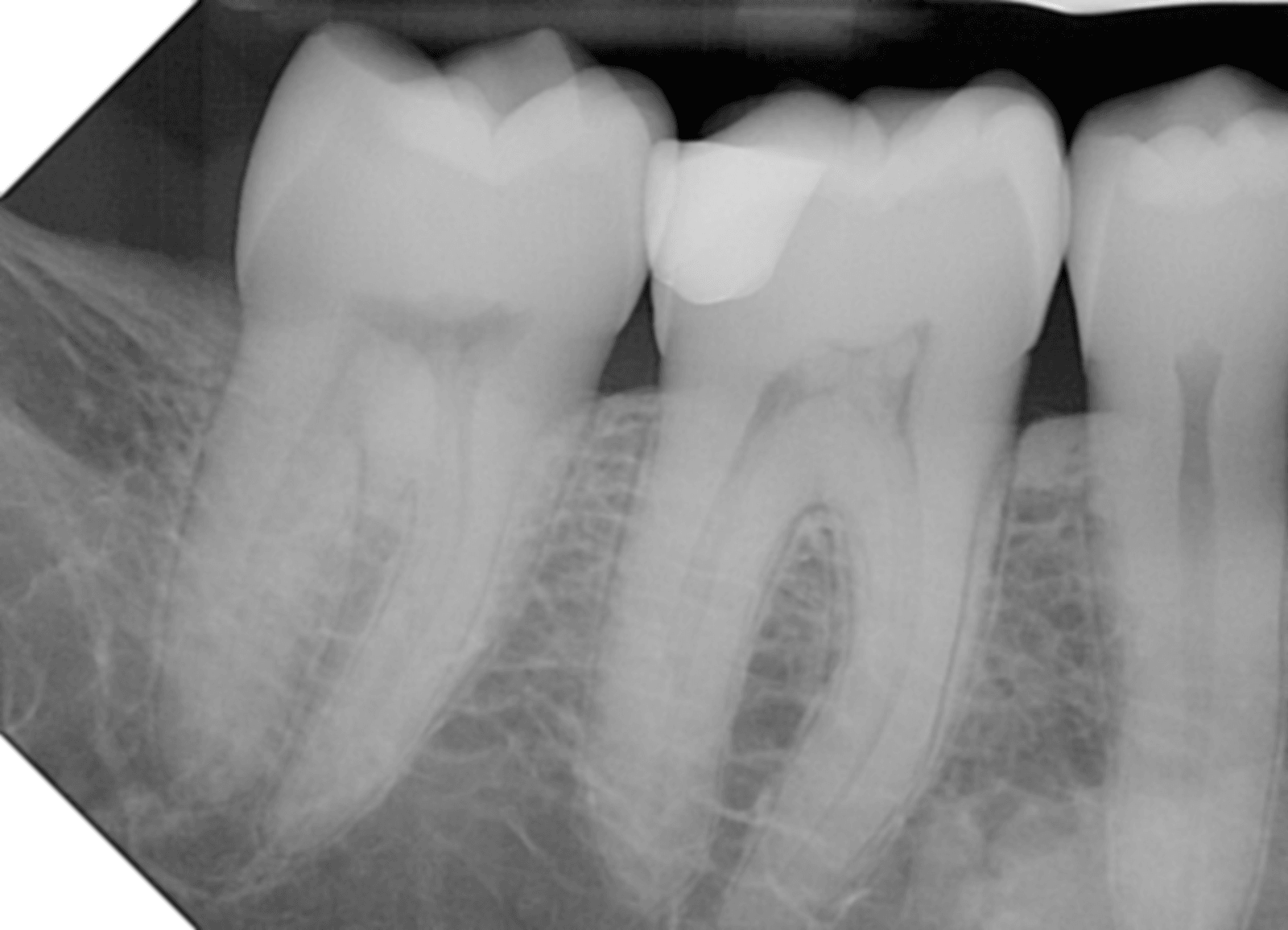 Minimally processed PrimeView Ultra x-ray with no post processing applied.