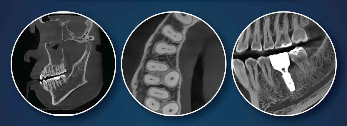 HDX WILL CBCT clinical examples showing a full-field sagittal view, a focused endodontic axial view, and anatomy beside an implant