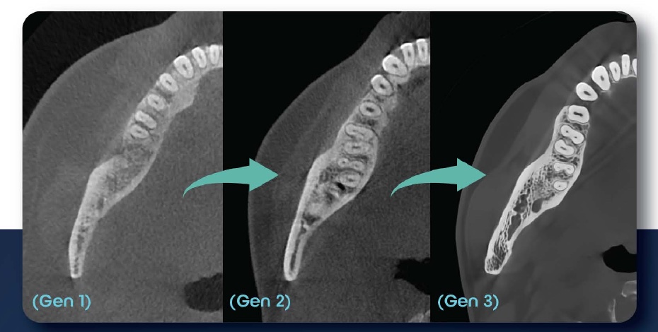 Three generations of HDX WILL CBCT reconstruction shown side by side in axial views