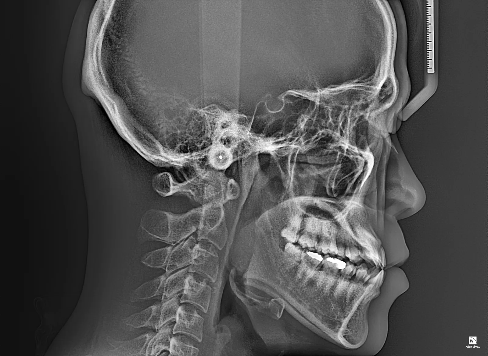 Lateral cephalometric radiograph captured in a single shot on an HDX Will Dentri system