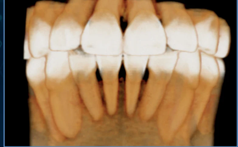High-resolution 3D CT reconstruction of anterior teeth, captured at the Excelsior Endo's 48 µm voxel resolution
