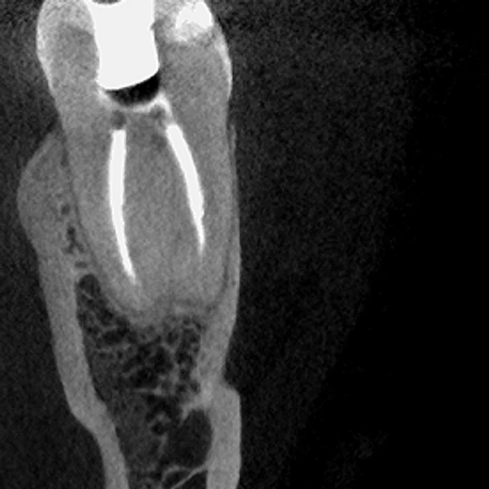 High-resolution CT reconstruction of a molar root canal, captured on the Excelsior Endo
