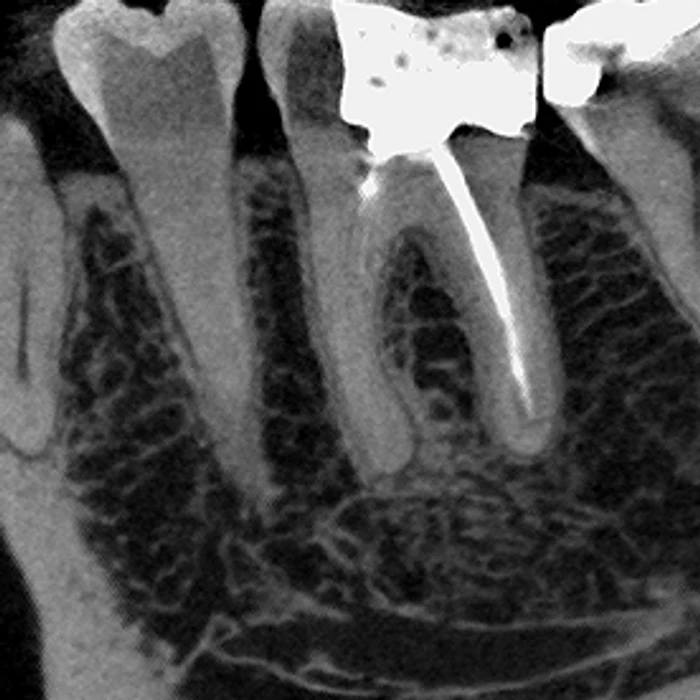 High-resolution CT reconstruction of a treated molar and adjacent teeth, captured on the Excelsior Endo