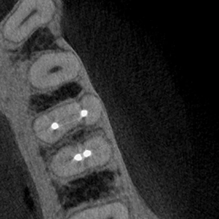 High-resolution CT reconstruction of a root-canal-treated premolar, captured on the Excelsior Endo