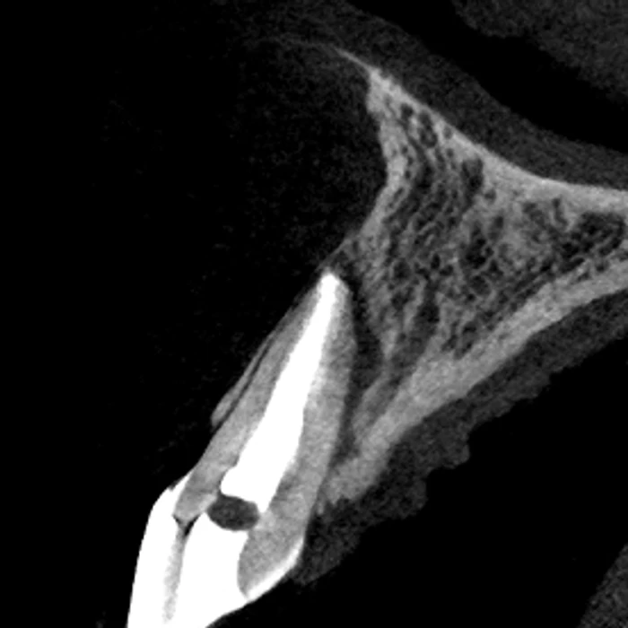 High-resolution CT reconstruction of a molar root and surrounding bone, captured on the Excelsior Endo