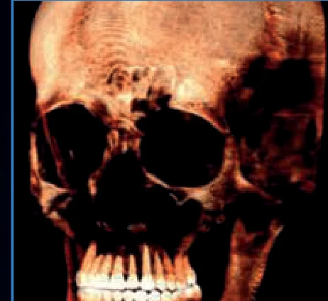 3D CT reconstruction of a full cranium, captured at the Excelsior Max's largest 16×21 cm field of view