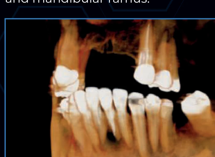 3D CT reconstruction of a full dental arch with an implant site, captured at the Excelsior Mid's 9×9 cm field of view