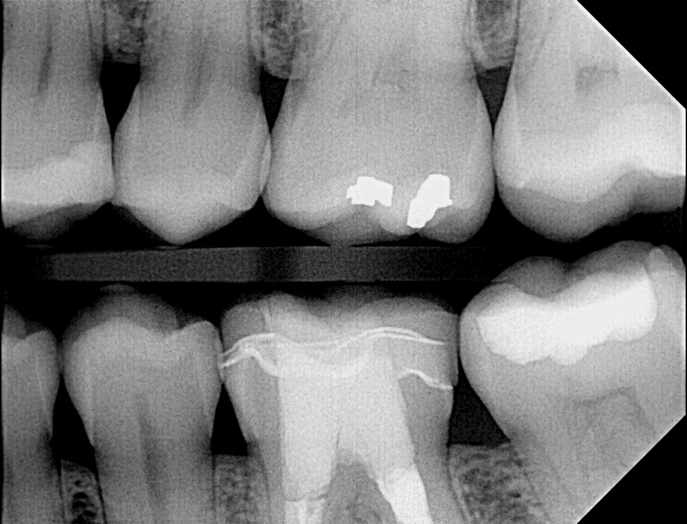 Radiograph captured with a conventional scintillator-based sensor