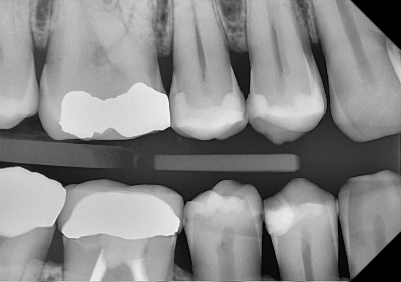 A DC-Air™ direct-conversion cuspid bitewing showing crisp crown margins, contacts, and enamel detail in the premolar region.