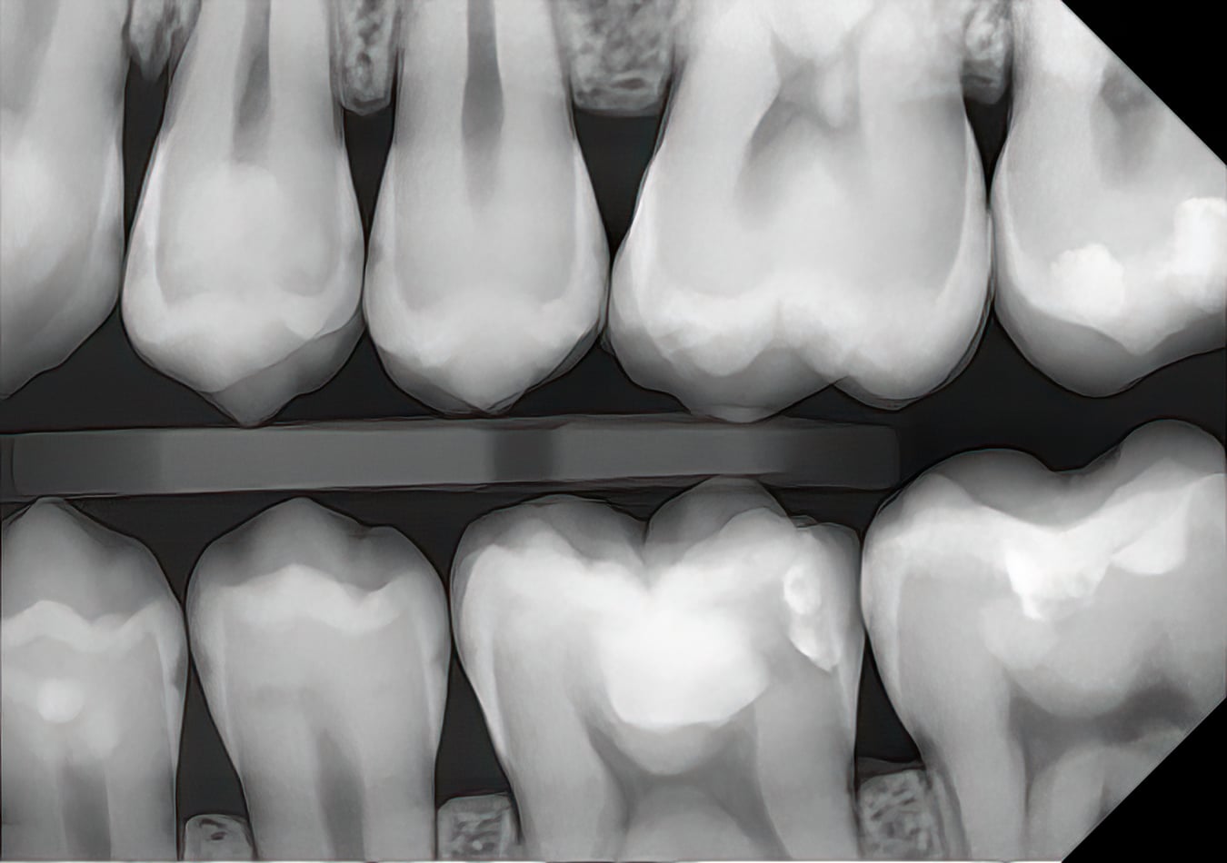 A DC-Air™ direct-conversion posterior bitewing at high magnification, showing crisp enamel, dentin, and interproximal detail with no software sharpening applied.