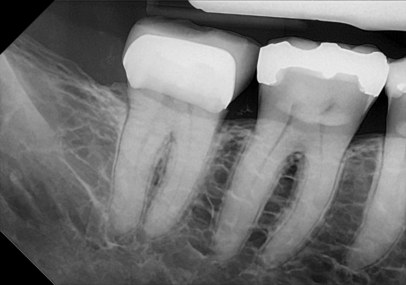 A DC-Air™ direct-conversion lower posterior periapical showing two crowned teeth with crisp root, canal, and alveolar bone trabeculation detail.